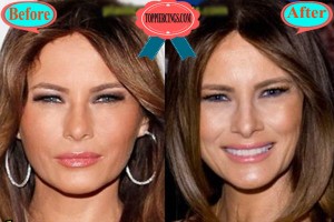 Melania Trump Denies Plastic Surgery: Breasts Before and After