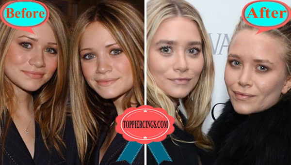 Mary Kate Olsen Before and After Plastic Surgery.