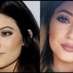Kylie Jenner Plastic surgery Before and after