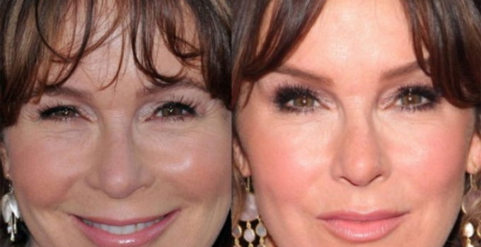 Marlo Thomas Plastic Surgery Before and After. 